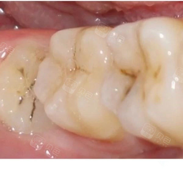 牙齿上的黑线条
