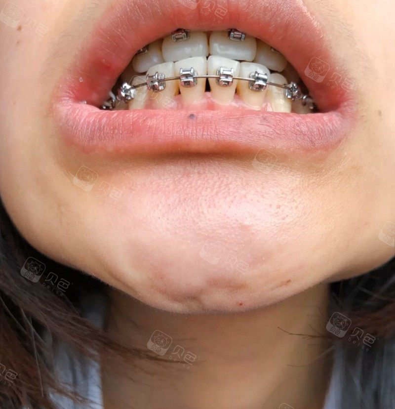 戴金属牙套矫正牙齿后出现了黑三角后悔吗