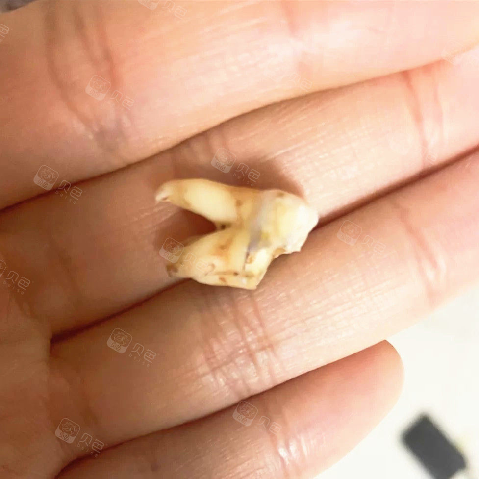 紧张刺激的拔牙后,还是选择种植牙