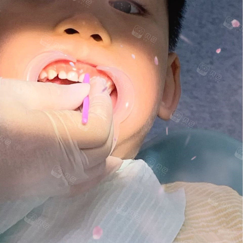 儿童涂氟很重要,当妈妈的要注意了