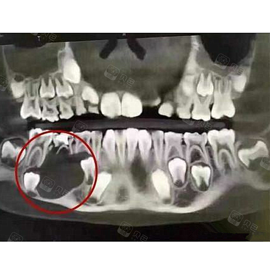 7岁孩子牙齿烂光,别让自己的疏忽毁了孩子一生