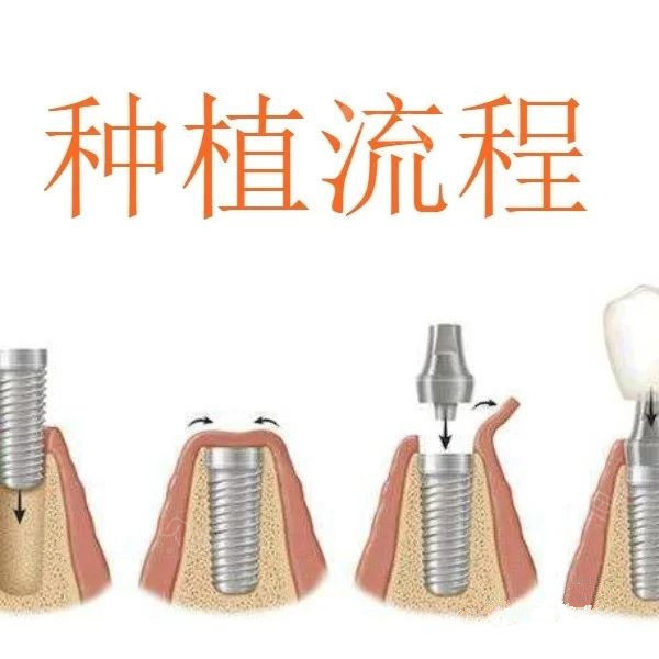 种植牙流程