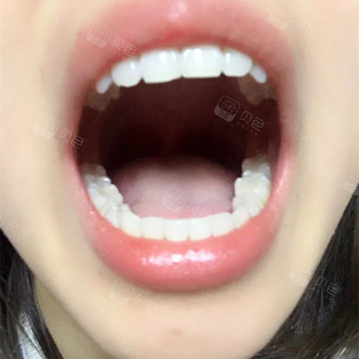 幸亏去医院及时,否则这两颗牙齿就废了