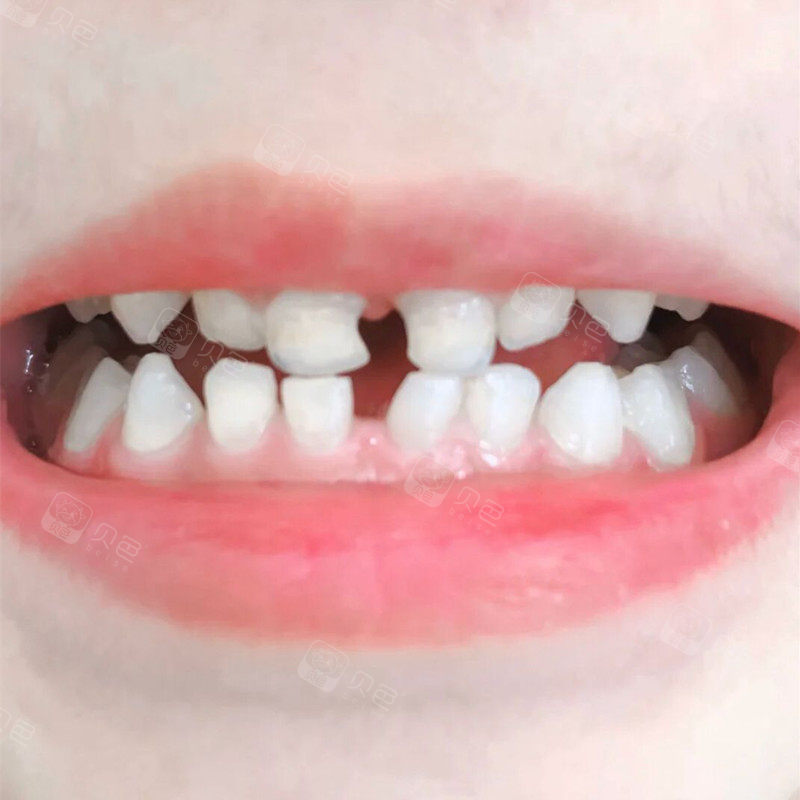 0元 口腔项目  儿童口腔 恢复时间  0天 收藏 我家乖儿子的牙齿我