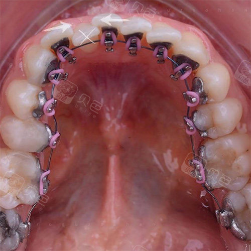 舌侧隐形矫正器