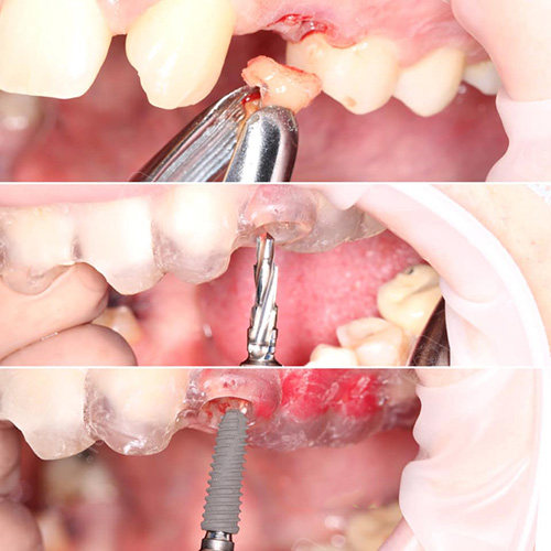 3d数字导板种植