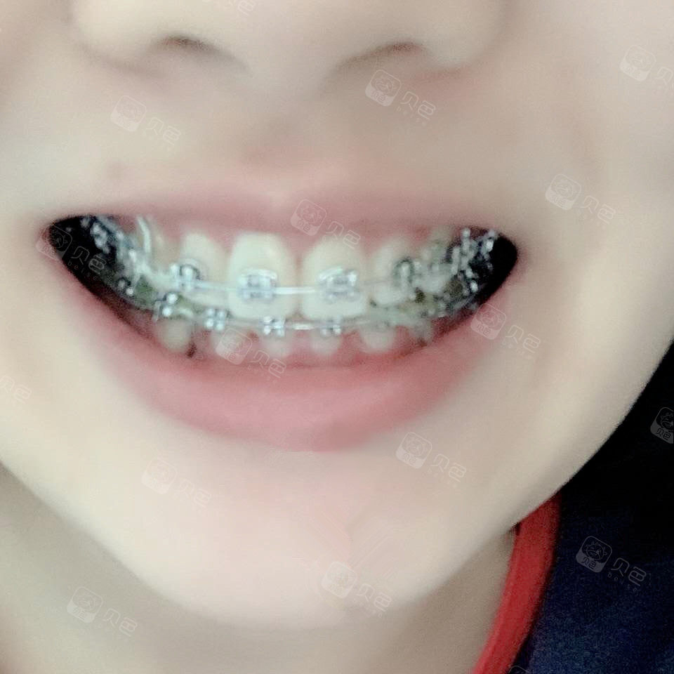 正畸一定不会后悔 如果有那就是矫正晚了 贝色口腔