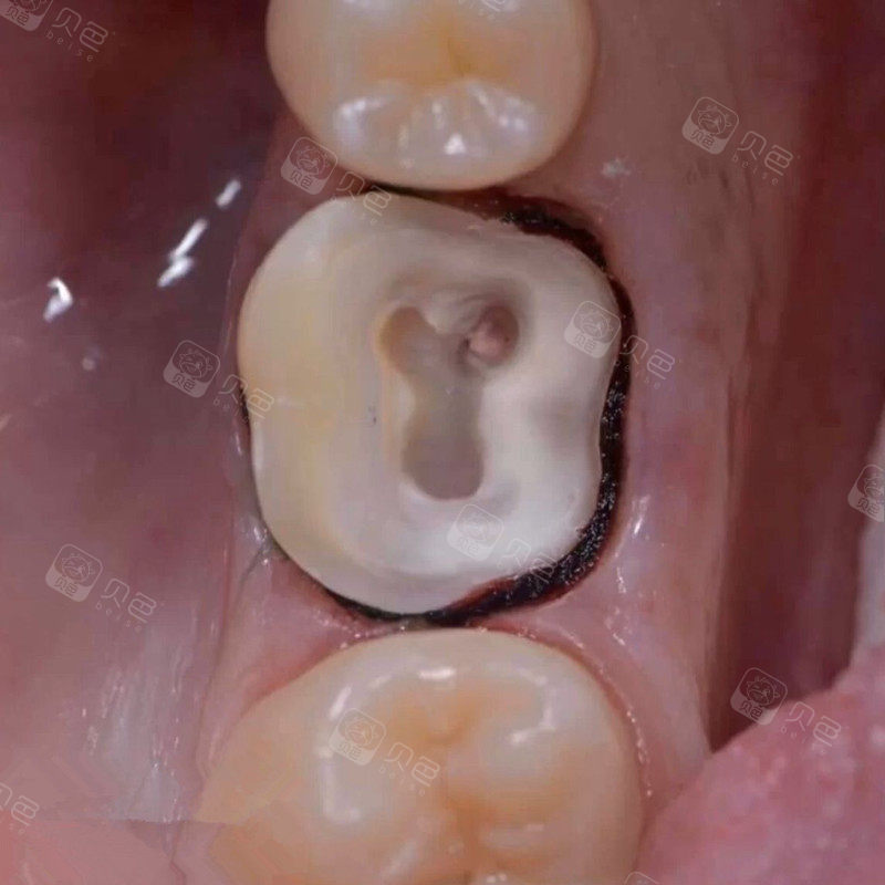 你的残冠牙齿有没有做个"安全帽"? - 贝色口腔