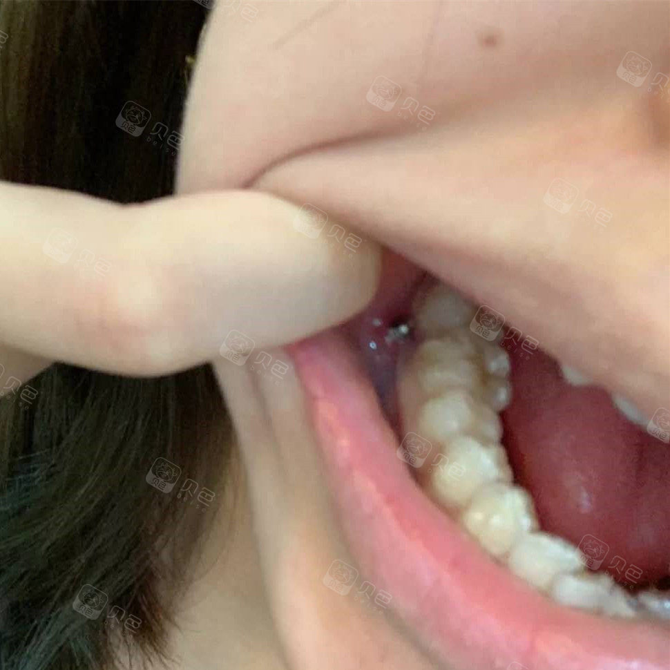 亲身经历隐形矫正有时候也需要打支抗钉