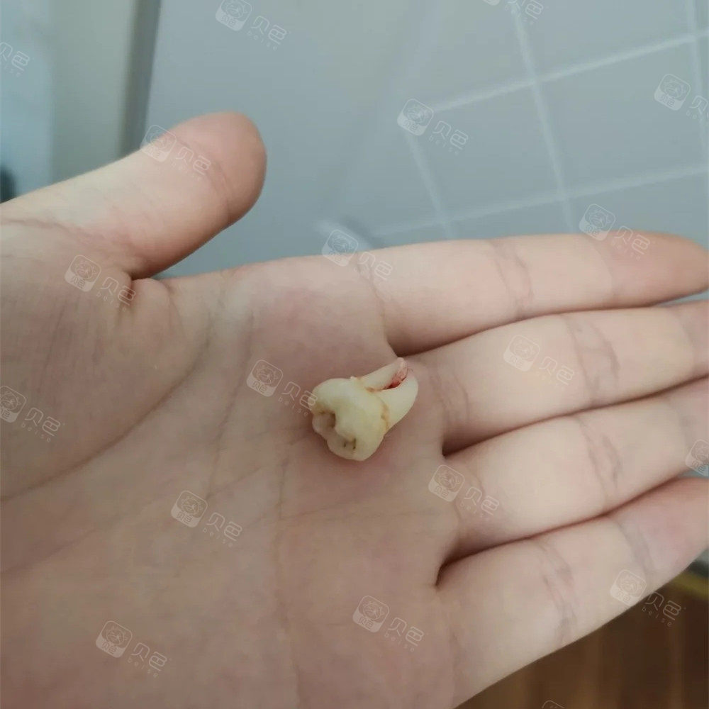 拔掉的智齿