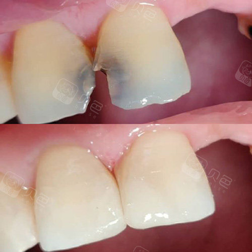 我的门牙邻面龋要不要补啊?龋洞在侧面医生不建议补是为什?