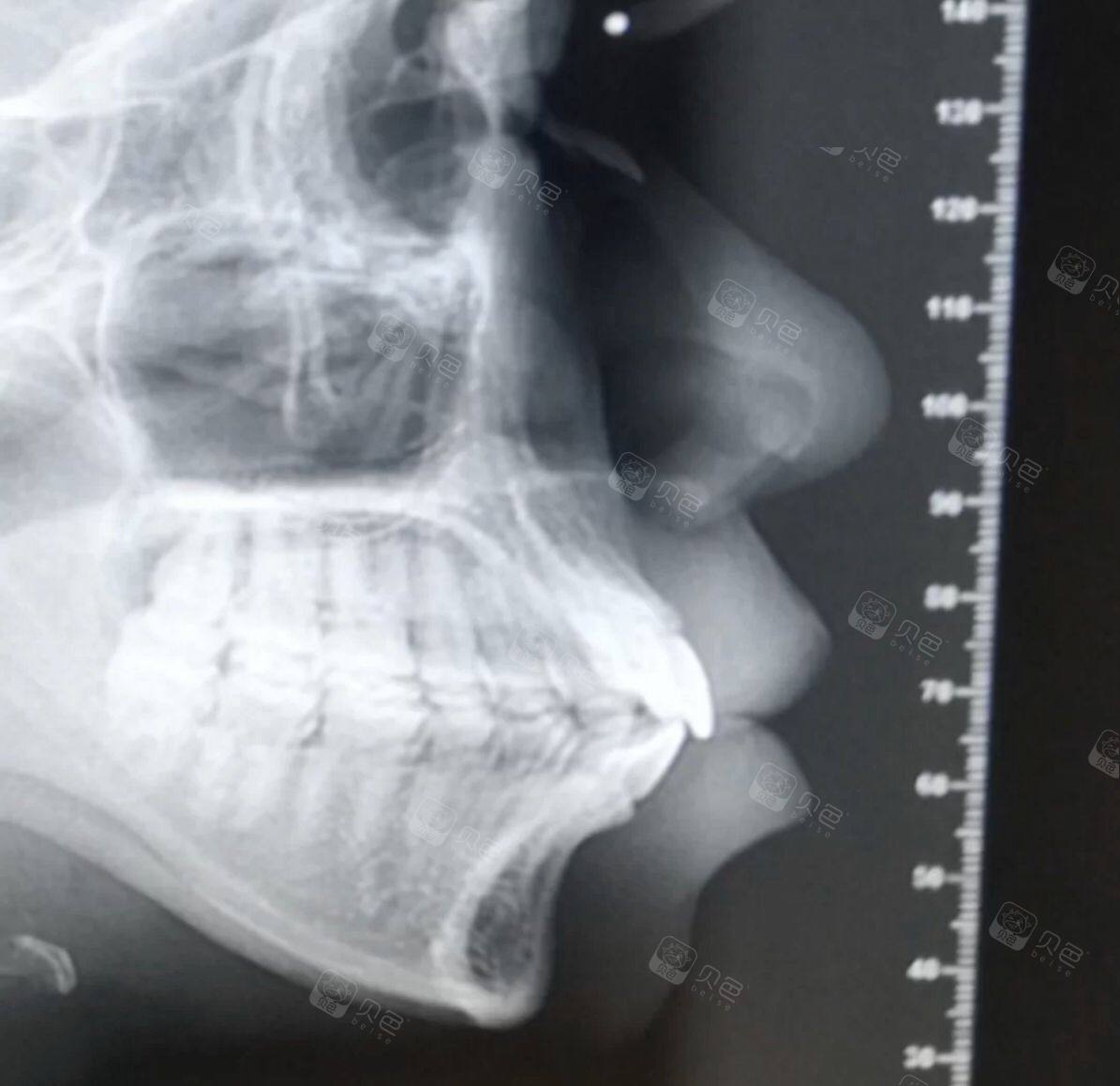 逛社区 >  牙友讨论 >  详细页面参考金额  0元 口腔项目  牙齿矫正