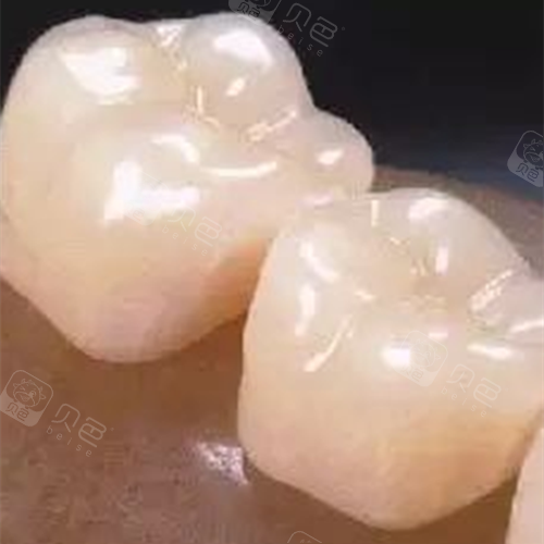 后槽牙做牙冠多少钱