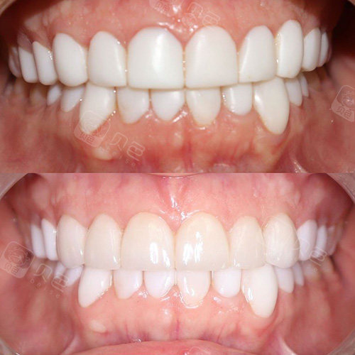 树脂贴面与瓷贴面效果对比