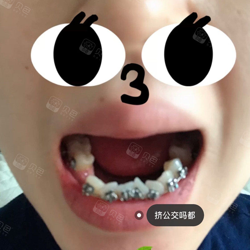 牙齿正畸:隐形时代天使 铁丝前期 - 贝色口腔