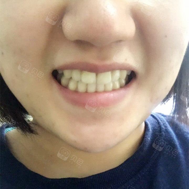 门牙牙缝树脂补牙利弊,大门牙树脂补牙缝图片,门牙补牙好还是贴面好(第15页)_大山谷图库