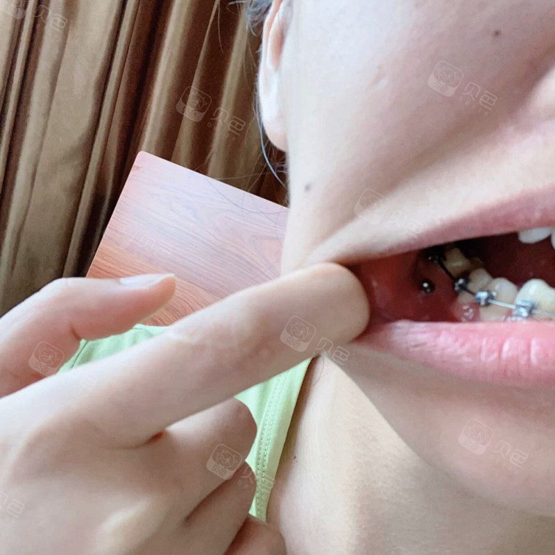 27岁矫牙求助盟友为啥打骨钉这么痛正常吗