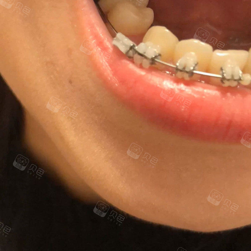 戴陶瓷半隐形牙套快一年的记录