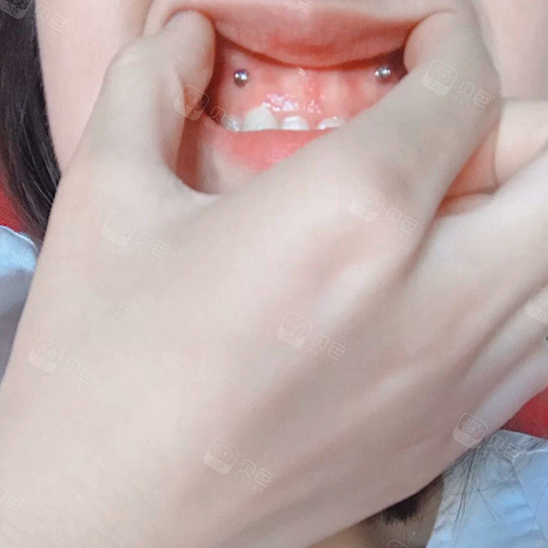 牙齿打骨钉