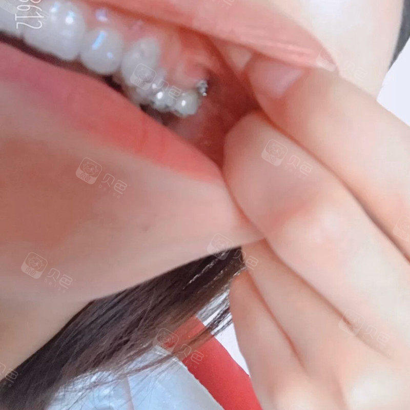 矫正 恢复时间  0天 收藏 我的方案是带到第五副牙套的时候要打骨钉