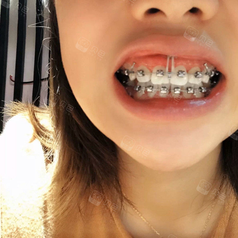 牙套进行时关于打支抗钉和挂皮筋