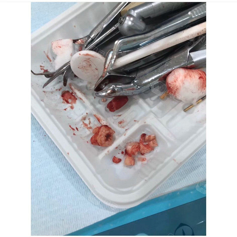 当时心情还是很复杂的,但是牙齿长得也不正,终归是要拔掉的