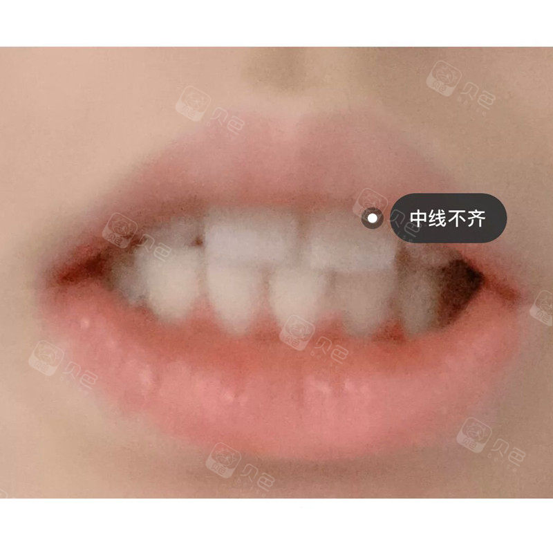 牙中线不齐