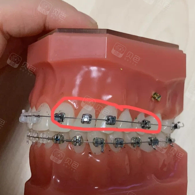 为了达到好的矫正效果 我也是拼了 打了很多次支抗钉