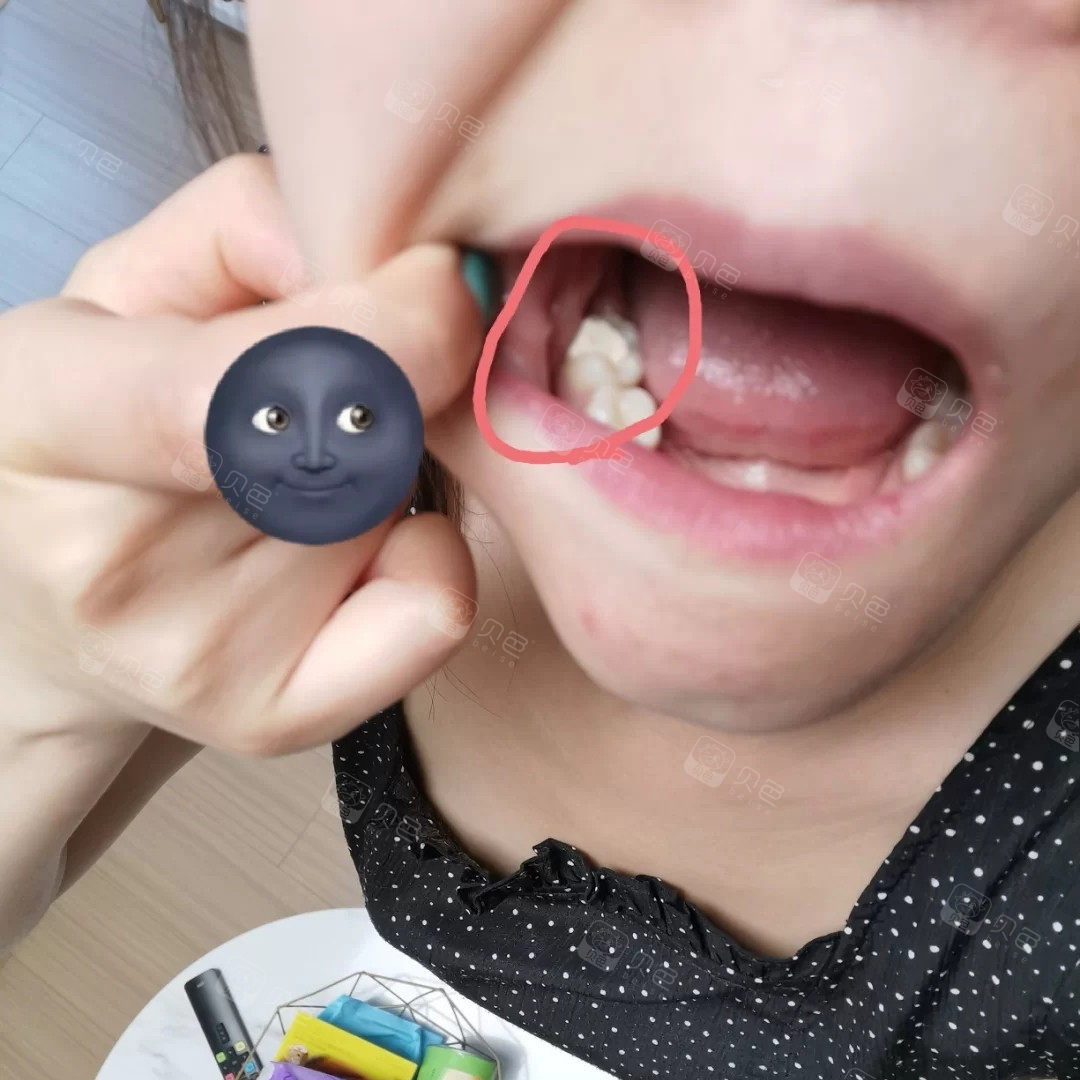 封药结束了还有神经没有杀死 这样的根管治疗肯定疼