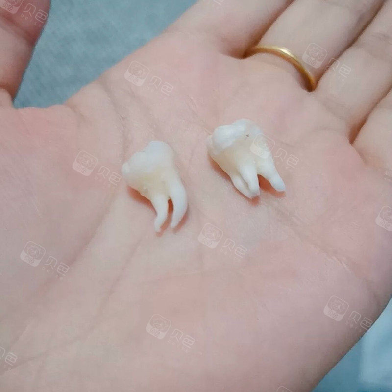 拔掉的牙齿