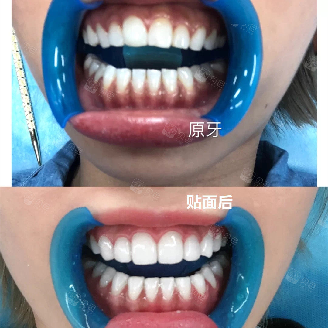 不用磨牙的全瓷牙贴面真香