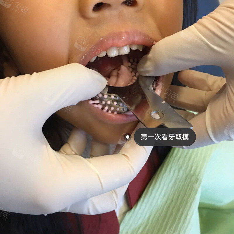 取牙模