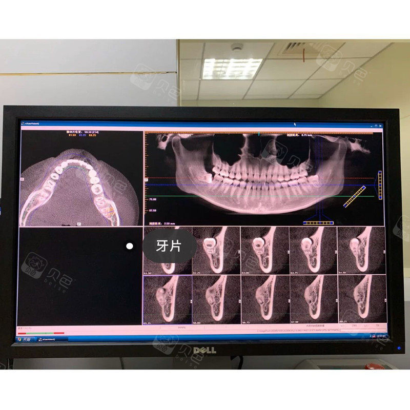智齿 恢复时间  0天 收藏 在牙齿发炎的第n次,去了医院拍了牙片,才