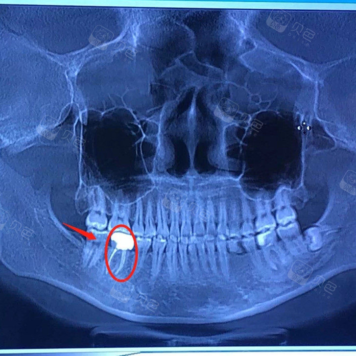 上海5次根管治疗,遇到好医生还可以刷医保