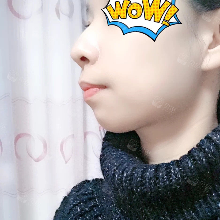 矫正前凸嘴比较明显