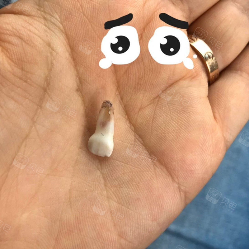 宝宝乳牙磕掉了!我自责了两个月