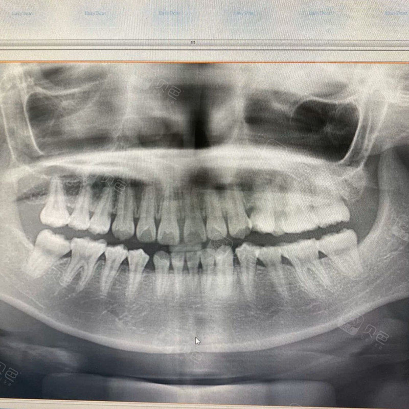拜托专业人士来看一下我的牙齿是黑三角了吗?