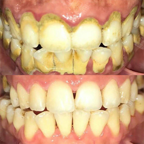 洁牙前后对比