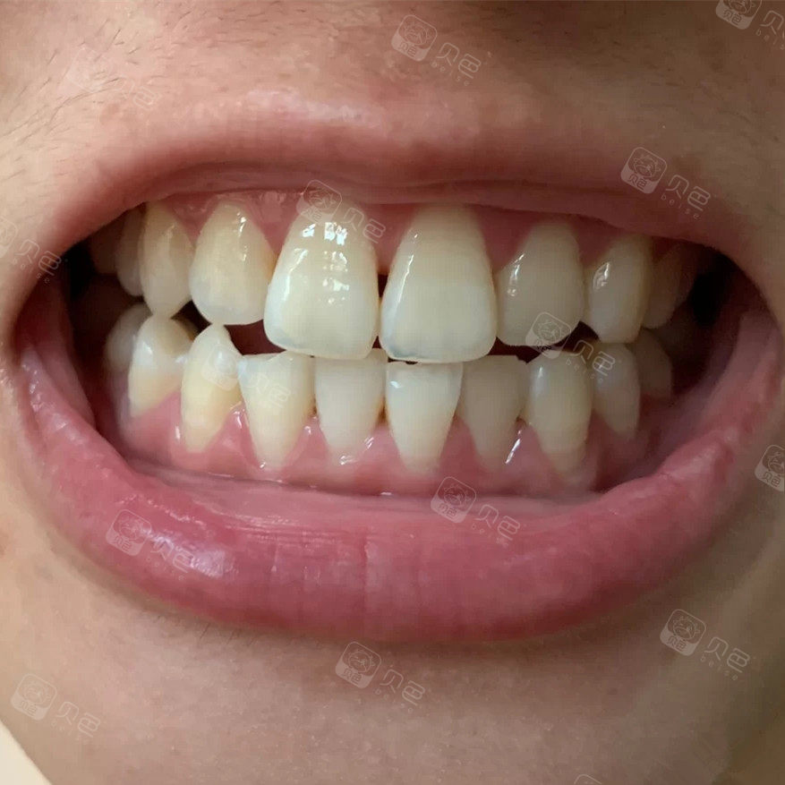 洗牙后会导致黑三角明显牙龈萎缩?