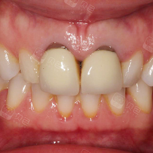 纯钛烤瓷牙和全瓷牙哪个耐用?后牙做全瓷还是纯钛好?