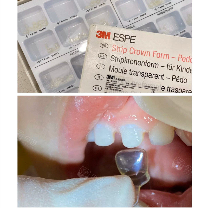 孩子乳牙预成冠