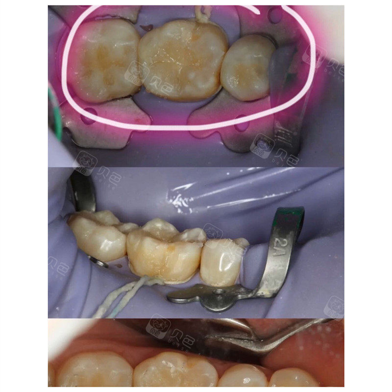 开启正畸前的修修补补之看蛀牙补牙