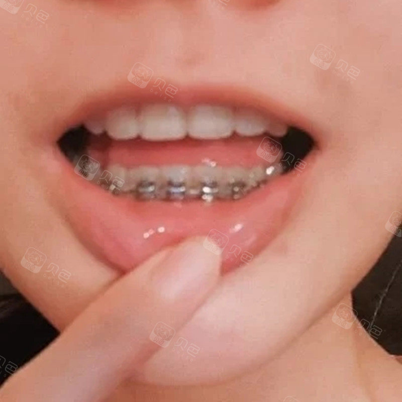 牙齿不整齐还能容忍 龅牙不矫正简直惨不忍睹