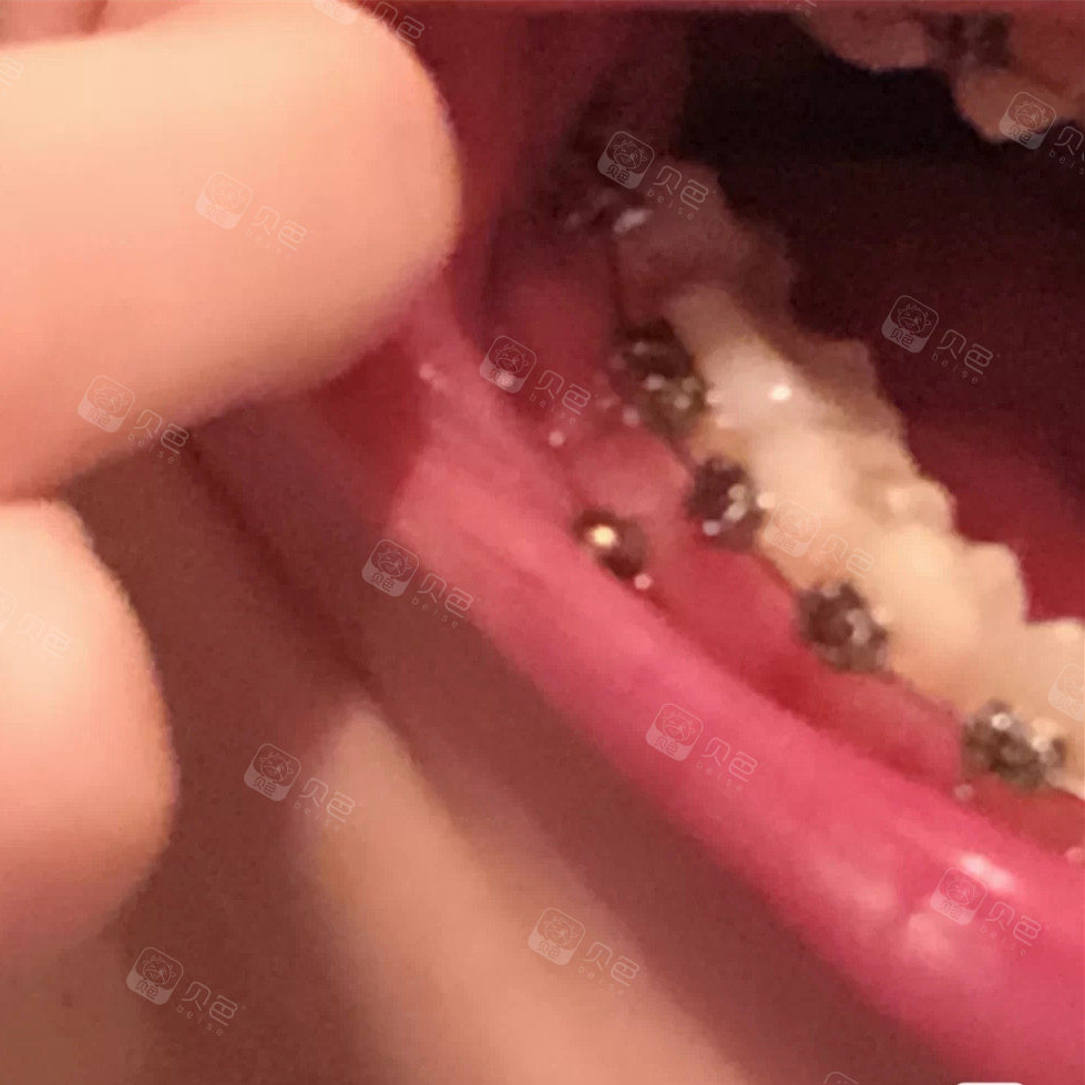 掉骨钉 掉托槽 牙齿脱离矫正器 不复诊都还不知道