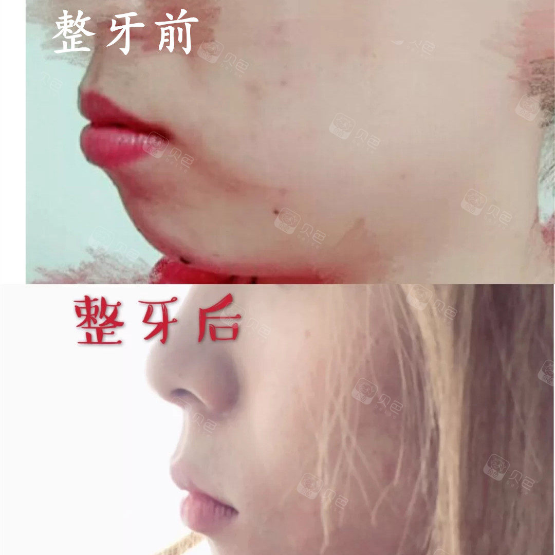 骨性龅牙的正畸矫正效果 个人感觉非常满意