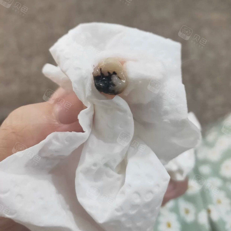人生头一次拔智齿 真的是龋坏到很黑的程度