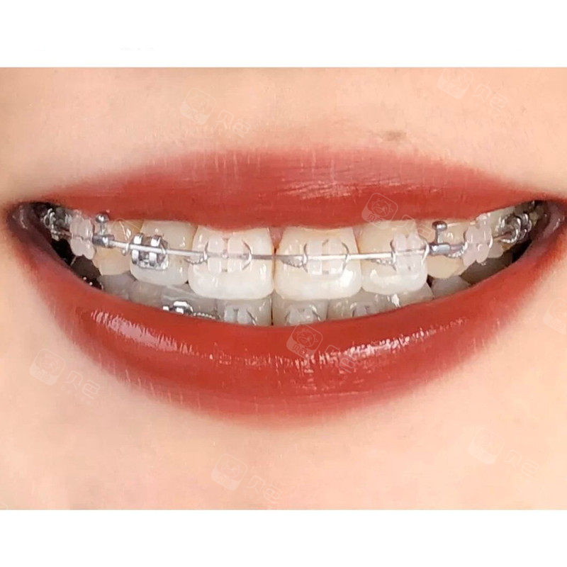 牙套正畸496天可怕的黑三角牙龈又长出来了