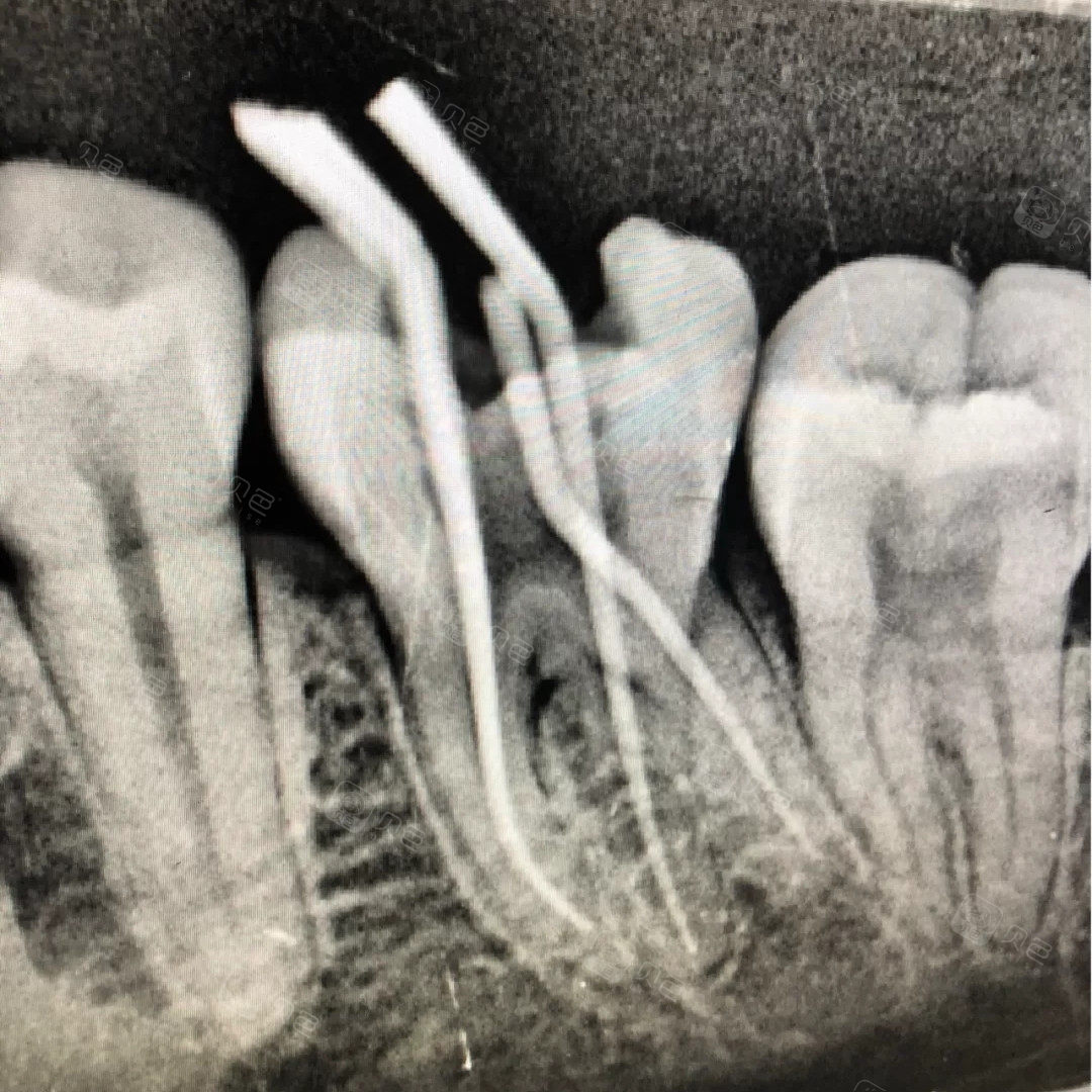 自己做完根管治疗后才发现是真的不疼 关键看医生技术