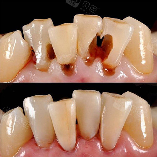 详细页面参考金额  200元 口腔项目  补牙 恢复时间  1天 收藏 补完牙