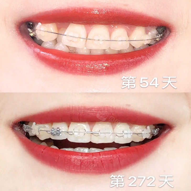 陶瓷牙套10个月更新中好担心瘪嘴阿